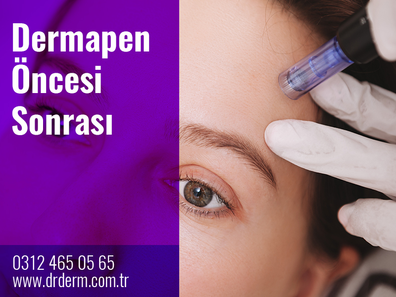 Dermapen Öncesi Sonrası