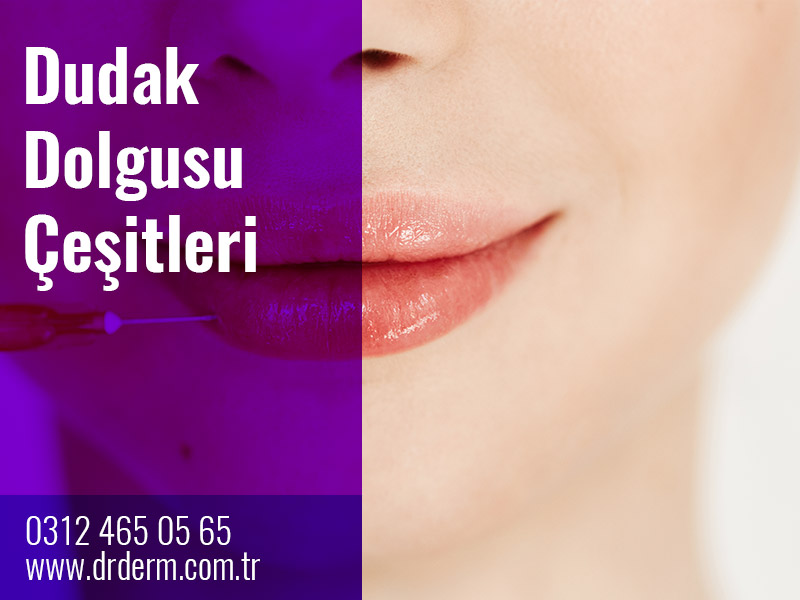 Dudak Dolgusu Çeşitleri