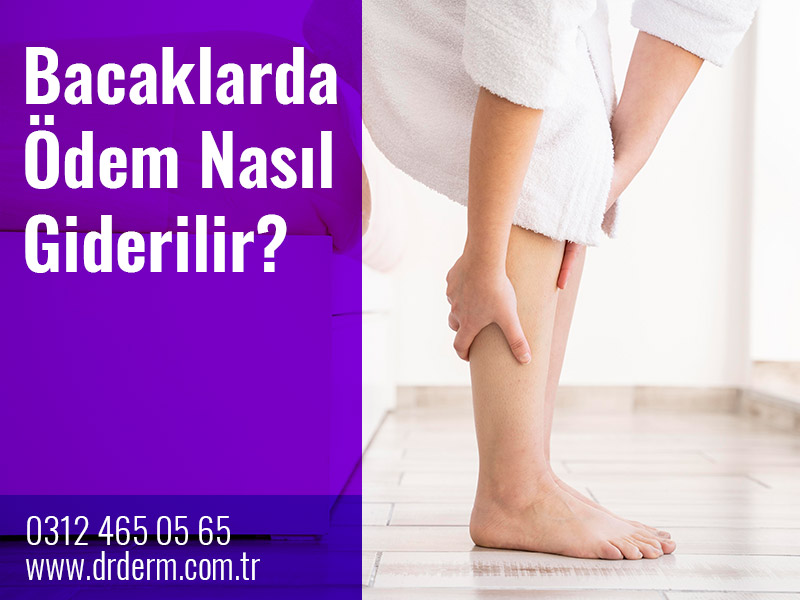 Bacaklarda Ödem Nasıl Giderilir?