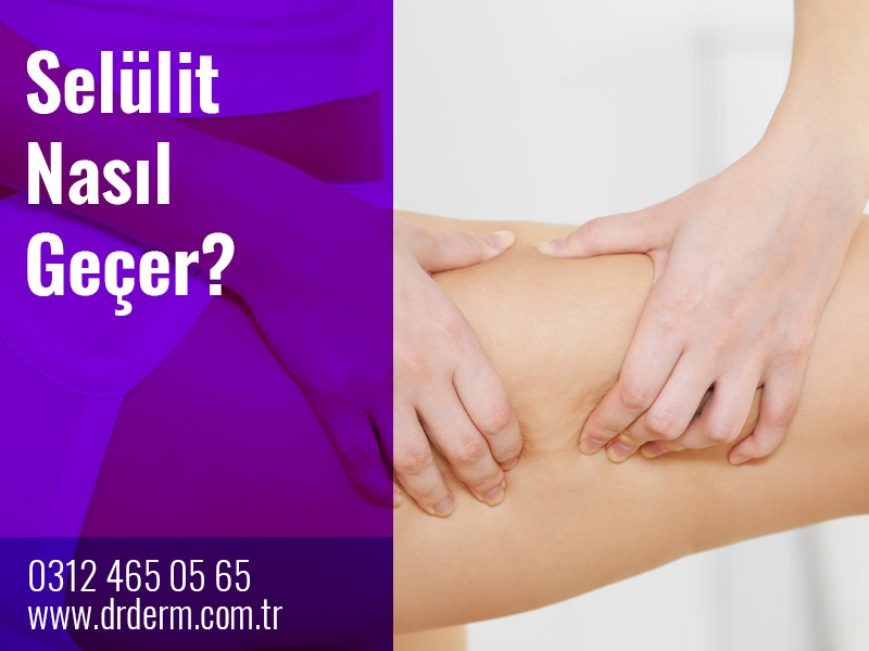 Selülit Nasıl Geçer?
