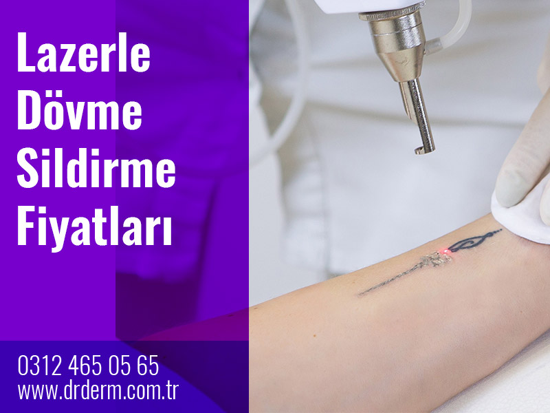Lazerle Dövme Sildirme Fiyatları