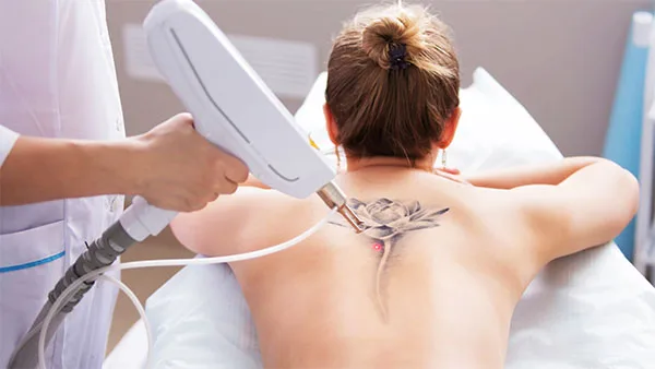 lazerle dövme silme işlemi