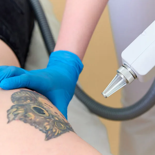 lazerle dövme silme